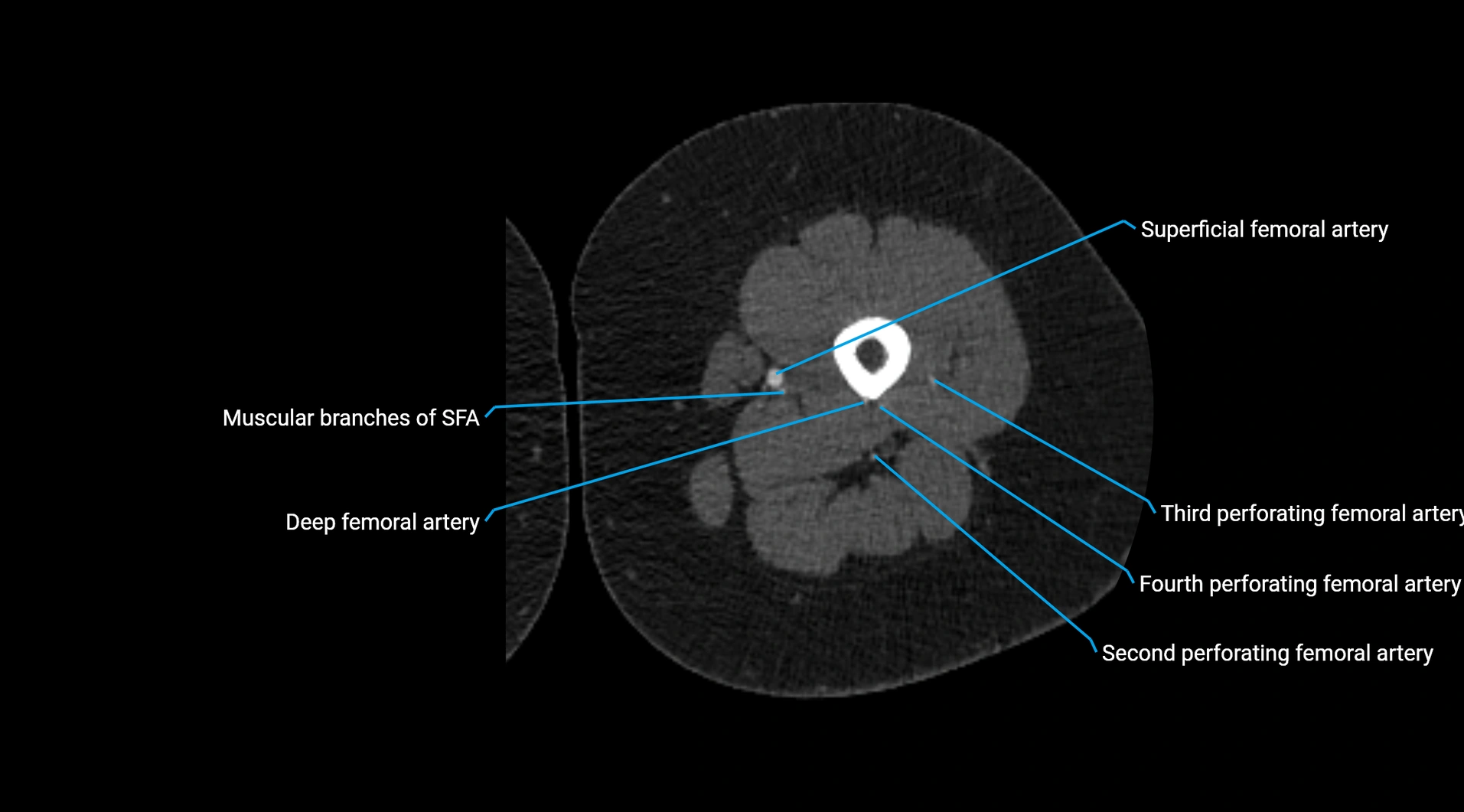 CTA lower limb cross sectional anatomy labelled image _127.webp